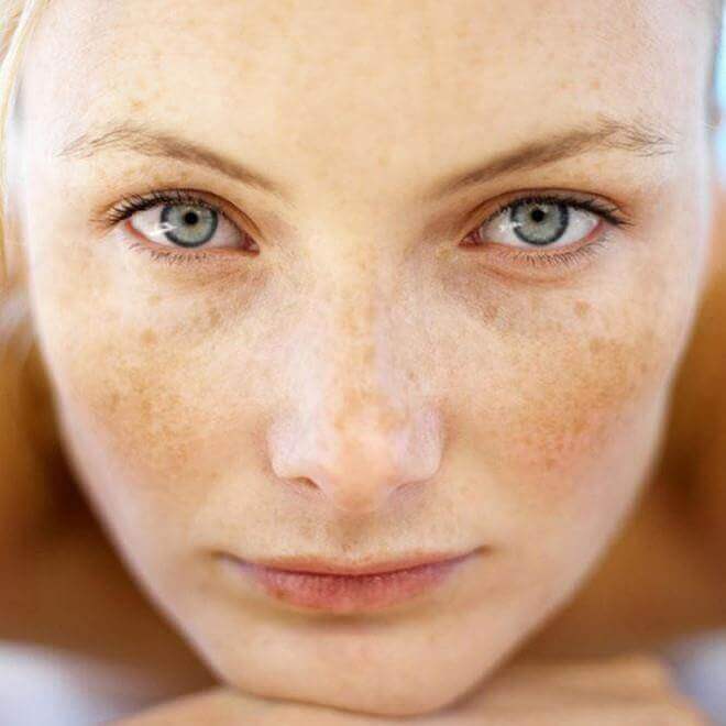 Bật mí bí quyết giúp ngừa tăng sắc tố da vào mùa hè 53