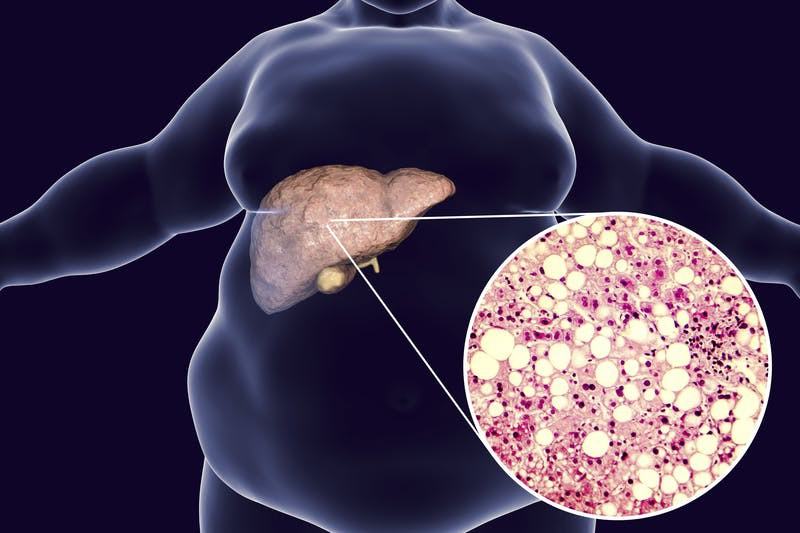 Những biểu hiện của bệnh gan nhiễm mỡ mà bạn nên sớm phát hiện trước khi dẫn đến ung thư gan - Ảnh 9.