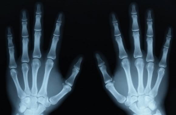 Cách chính xác nhất phân biệt bong gân cổ tay và gãy xương cổ tay để xác định cần phải nhập viện hay không - Ảnh 5.