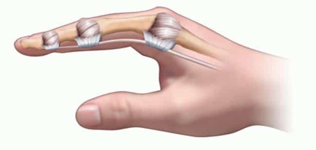 Cách chính xác nhất phân biệt bong gân cổ tay và gãy xương cổ tay để xác định cần phải nhập viện hay không - Ảnh 2.