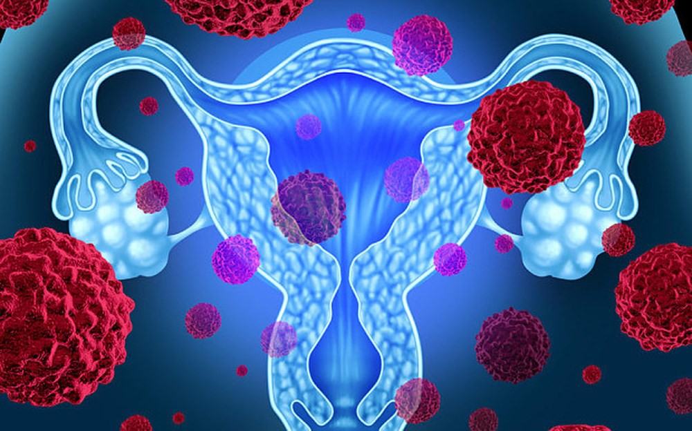 Đây là 4 căn bệnh ung thư thường gặp ở nữ giới mà bạn nên tìm hiểu ngay từ bây giờ - Ảnh 3.