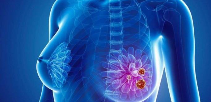 Những giai đoạn của ung thư vú và cách điều trị của từng giai đoạn mà bạn nên biết - Ảnh 2.