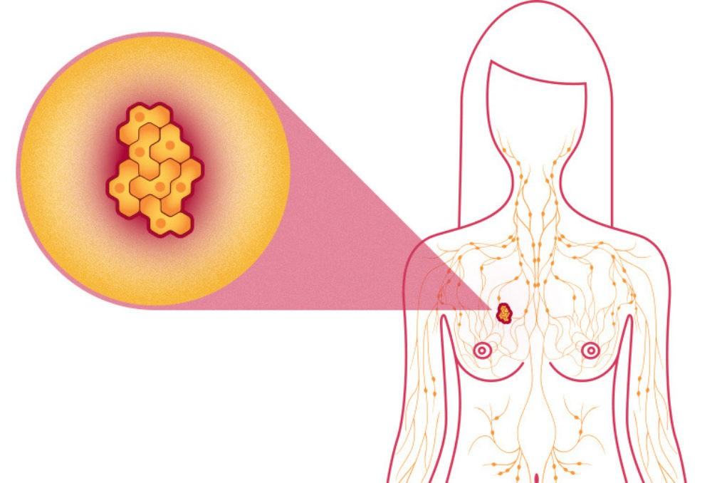 Đây là 4 căn bệnh ung thư thường gặp ở nữ giới mà bạn nên tìm hiểu ngay từ bây giờ - Ảnh 1.