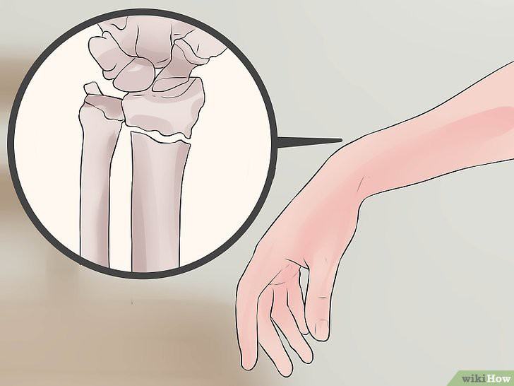 Cách chính xác nhất phân biệt bong gân cổ tay và gãy xương cổ tay để xác định cần phải nhập viện hay không - Ảnh 1.