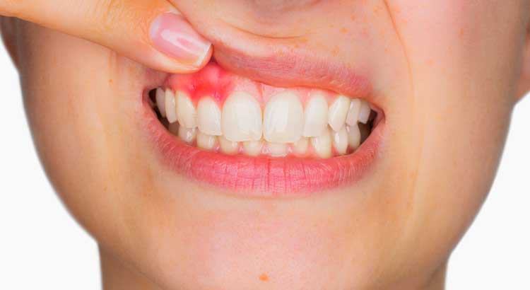 Những nguyên nhân cần lưu ý khi xuất hiện tình trạng chảy máu nướu khi đánh răng - Ảnh 1.