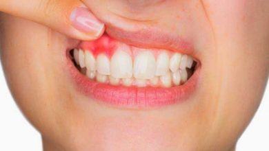 Những nguyên nhân chảy máu răng cần lưu ý khi đánh răng - Kiến Thức Chia Sẻ 6