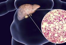 Những triệu chứng của bệnh gan nhiễm mỡ bạn nên sớm phát hiện trước khi dẫn đến ung thư gan - Kiến Thức Chia Sẻ 17