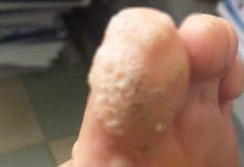 Mùa mưa bão đang đến gần, cẩn thận với các bệnh viêm nhiễm vùng da chân gây tổn thương tới làn da của bạn - Kiến Thức Chia Sẻ 3