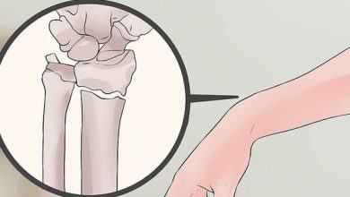 Cách chính xác nhất phân biệt bong gân cổ tay và gãy xương cổ tay để xác định cần phải nhập viện hay không - Kiến Thức Chia Sẻ 13