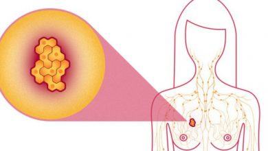 4 loại ung thư mà nữ giới có khả năng mắc phải rất cao - Kiến Thức Chia Sẻ 5