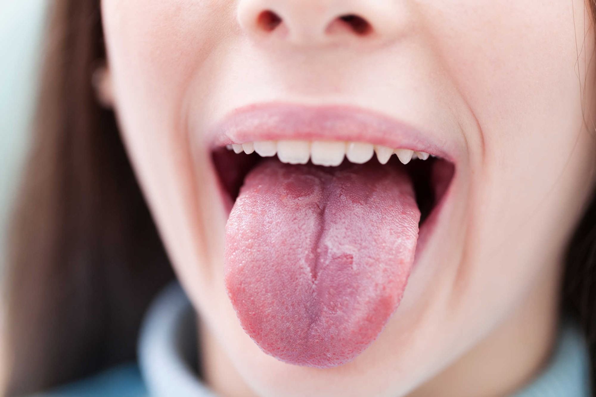 Những triệu chứng bất thường ở lưỡi có thể cảnh báo bạn đang mắc các căn bệnh nguy hiểm - Ảnh 2.