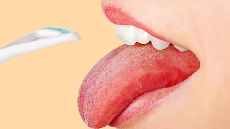 Những triệu chứng bất thường ở lưỡi có thể cảnh báo bạn đang mắc các căn bệnh nguy hiểm - Ảnh 3.