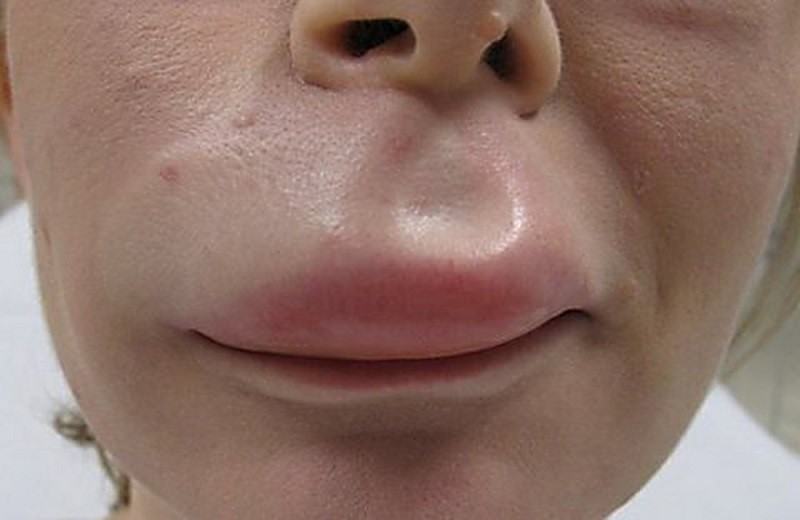 5 dấu hiệu bất thường ở đôi môi mà bạn không nên chủ quan bỏ qua - Ảnh 6.