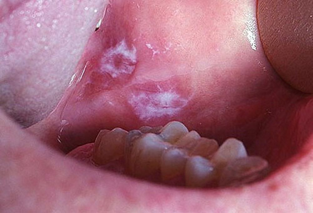 7 dấu hiệu cảnh báo ung thư miệng mà bạn tuyệt đối không nên chủ quan bỏ qua - Ảnh 5.