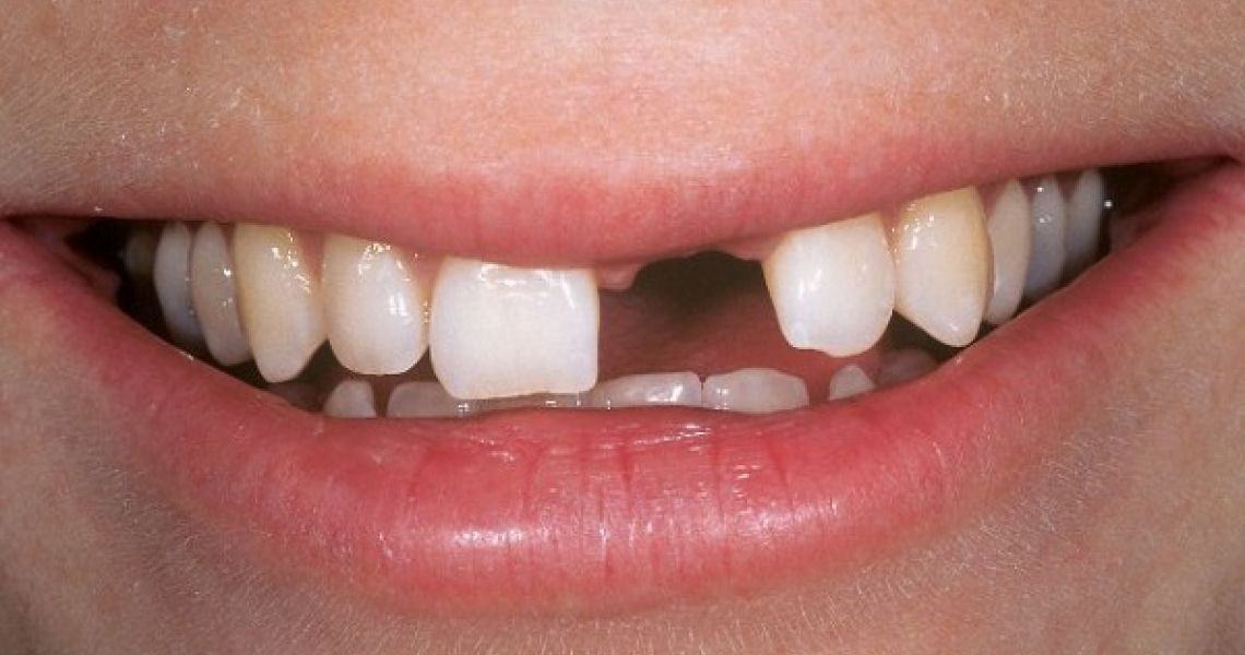 Biểu hiện lạ của răng miệng có thể cảnh báo những căn bệnh tiềm ẩn bên trong - Ảnh 4.
