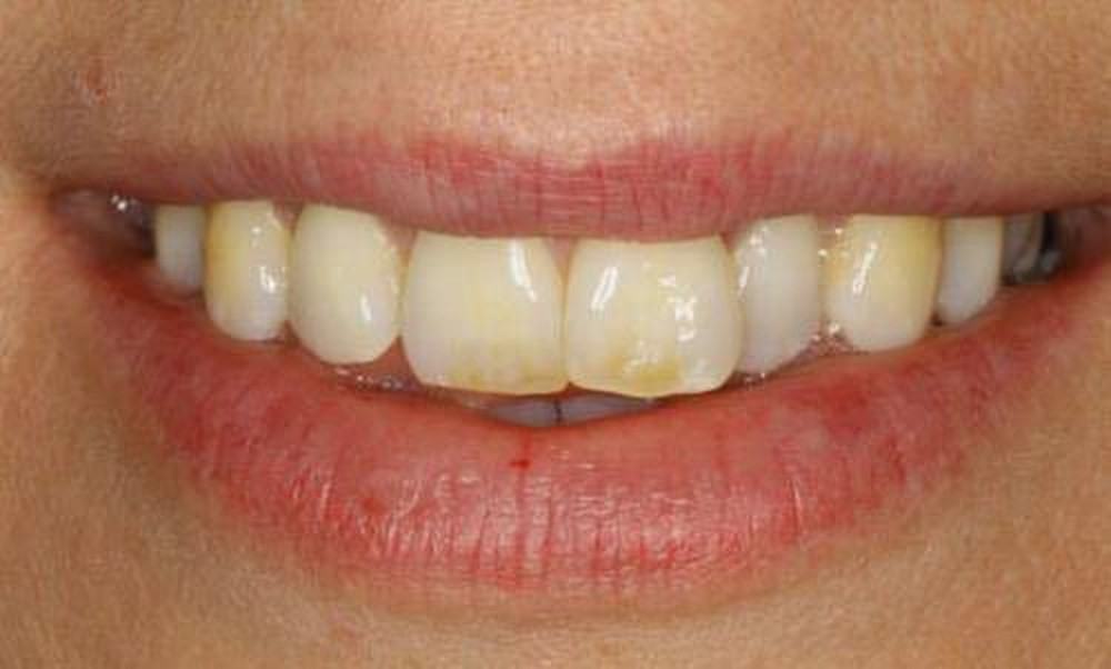 Biểu hiện lạ của răng miệng có thể cảnh báo những căn bệnh tiềm ẩn bên trong - Ảnh 6.