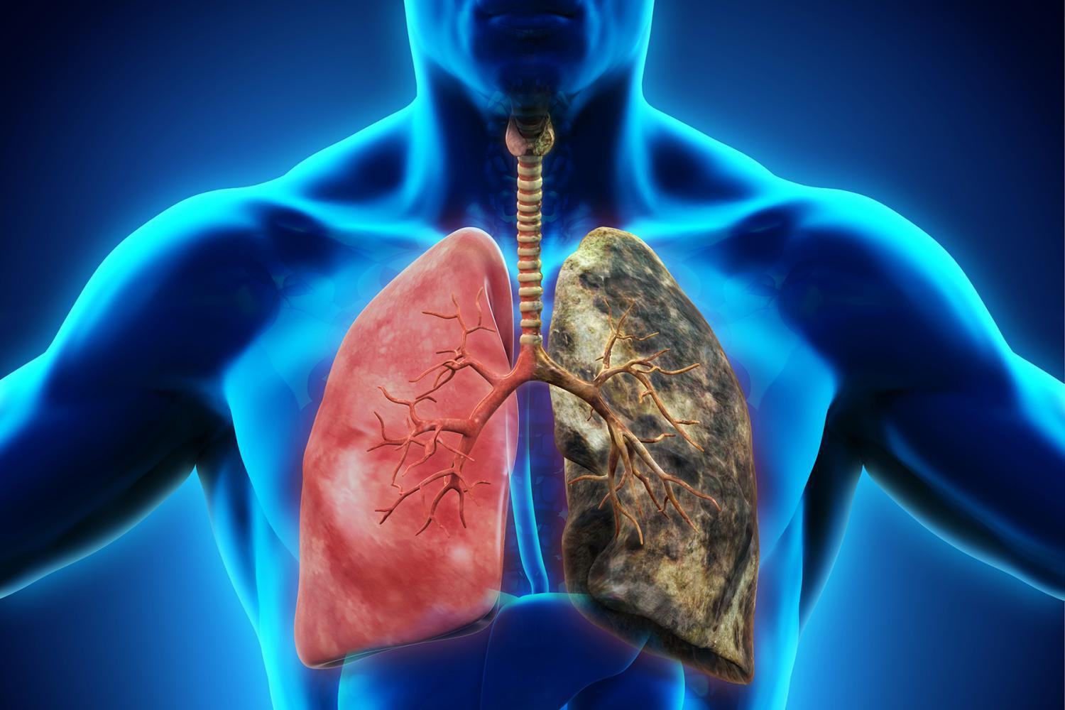 Ung thư phổi: Căn bệnh có thể mắc phải bất cứ lúc nào và nguyên nhân lại đến từ những thứ thân thuộc xung quanh bạn - Ảnh 5.