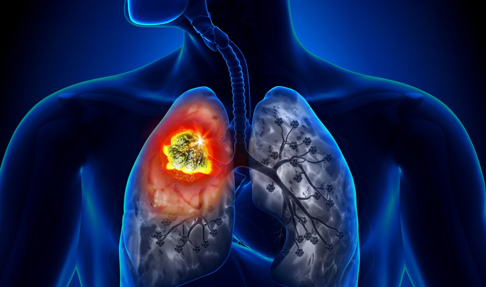 Ung thư phổi: Căn bệnh có thể mắc phải bất cứ lúc nào và nguyên nhân lại đến từ những thứ thân thuộc xung quanh bạn - Ảnh 2.