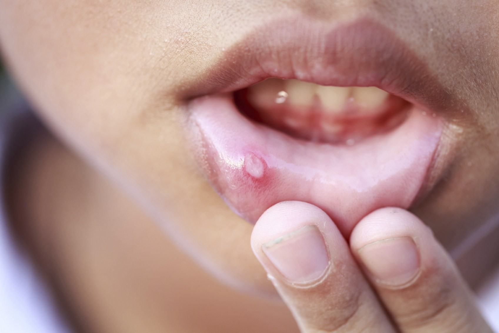 7 dấu hiệu cảnh báo ung thư miệng mà bạn tuyệt đối không nên chủ quan bỏ qua - Ảnh 1.