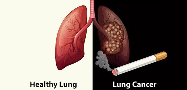 Có 20.000 người Việt Nam mắc ung thư phổi mỗi năm, nên làm gì để phát hiện sớm căn bệnh này? - Kiến Thức Chia Sẻ 2