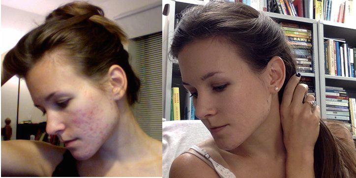 Cô gái người Mỹ kiên trì theo đuổi chế độ detox giúp đánh bay mụn chi chít trên khuôn mặt sau 1 năm - Ảnh 1.