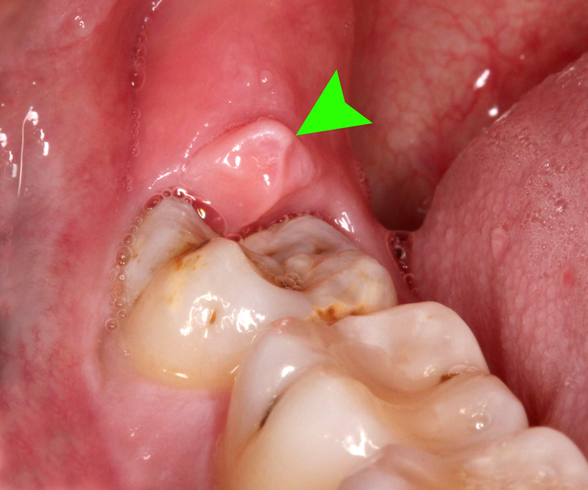 Đây là 4 thời điểm tuyệt đối không được nhổ răng khôn kẻo gây biến chứng nguy hại tới sức khỏe - Ảnh 1.