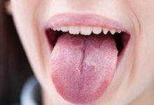 Những triệu chứng bất thường ở lưỡi có thể cảnh báo bạn đang mắc các căn bệnh nguy hiểm - Kiến Thức Chia Sẻ 2