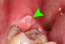 Đây là 4 thời điểm cần tránh nhổ răng khôn kẻo gây biến chứng nguy hại tới sức khỏe - Kiến Thức Chia Sẻ 26