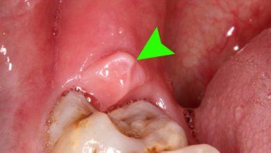 Đây là 4 thời điểm cần tránh nhổ răng khôn kẻo gây biến chứng nguy hại tới sức khỏe - Kiến Thức Chia Sẻ 4