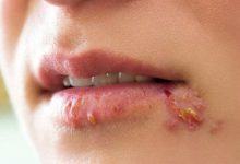 Các dấu hiệu của Herpes ở phụ nữ không nên bỏ qua - Kiến Thức Chia Sẻ 1