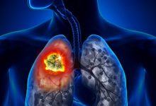 Bệnh ung thư phổi có thể mắc phải bất cứ lúc nào và nguyên nhân lại đến từ những thứ thân thuộc xung quanh bạn - Kiến Thức Chia Sẻ 13