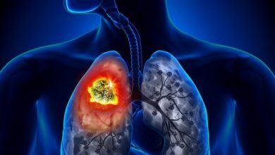 Bệnh ung thư phổi có thể mắc phải bất cứ lúc nào và nguyên nhân lại đến từ những thứ thân thuộc xung quanh bạn - Kiến Thức Chia Sẻ 7
