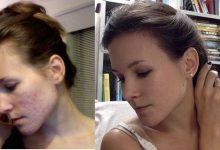 Cô gái người Mỹ kiên trì theo đuổi phương pháp detox giúp đánh bay mụn chi chít trên khuôn mặt sau 1 năm - Kiến Thức Chia Sẻ 4