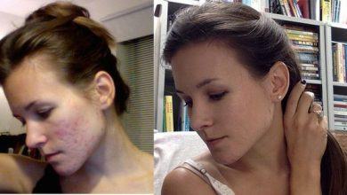 Cô gái người Mỹ kiên trì theo đuổi phương pháp detox giúp đánh bay mụn chi chít trên khuôn mặt sau 1 năm - Kiến Thức Chia Sẻ 7