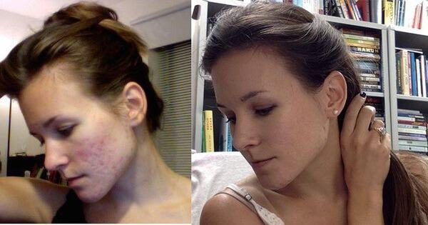 Cô gái người Mỹ kiên trì theo đuổi phương pháp detox giúp đánh bay mụn chi chít trên khuôn mặt sau 1 năm - Kiến Thức Chia Sẻ 1