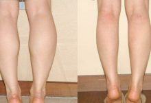 4 nguyên nhân khiến bắp chân phình to mất kiểm soát - Kiến Thức Chia Sẻ 4