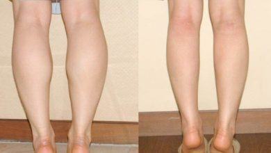 4 nguyên nhân khiến bắp chân phình to mất kiểm soát - Kiến Thức Chia Sẻ 5