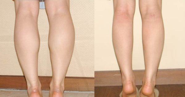 4 nguyên nhân khiến bắp chân phình to mất kiểm soát - Kiến Thức Chia Sẻ 1