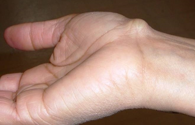 Bàn tay đột nhiên tê ngứa, mất cảm giác có thể là do những vấn đề sức khỏe sau đây gây ra - Ảnh 4.