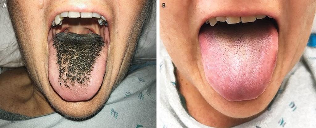 "Lông mọc trong lưỡi" - căn bệnh cực hiếm chứng minh rằng chuyện quái gì cũng có thể xảy ra - Kiến Thức Chia Sẻ 8