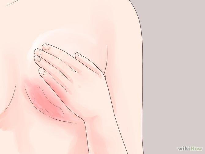 Ngực thường xuyên ngứa dữ dội có thể ngầm cảnh báo 5 vấn đề sức khỏe sau đây - Ảnh 5.