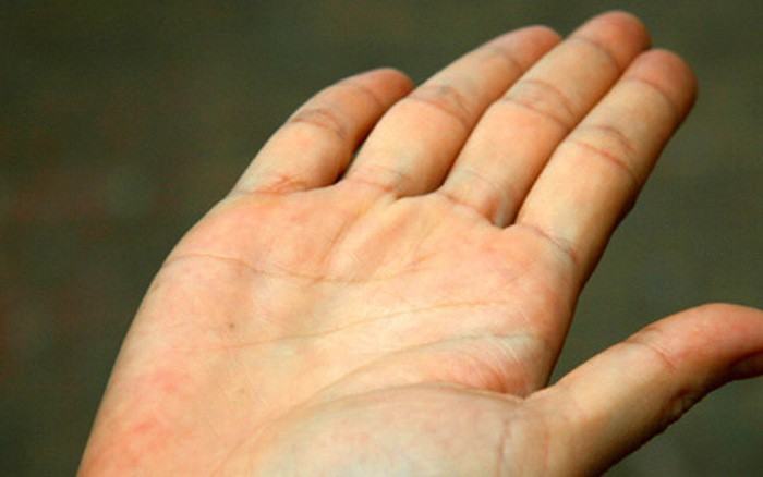 5 dấu hiệu của bệnh suy giáp thông qua các biểu hiện khác thường ở đôi bàn tay - Ảnh 3.