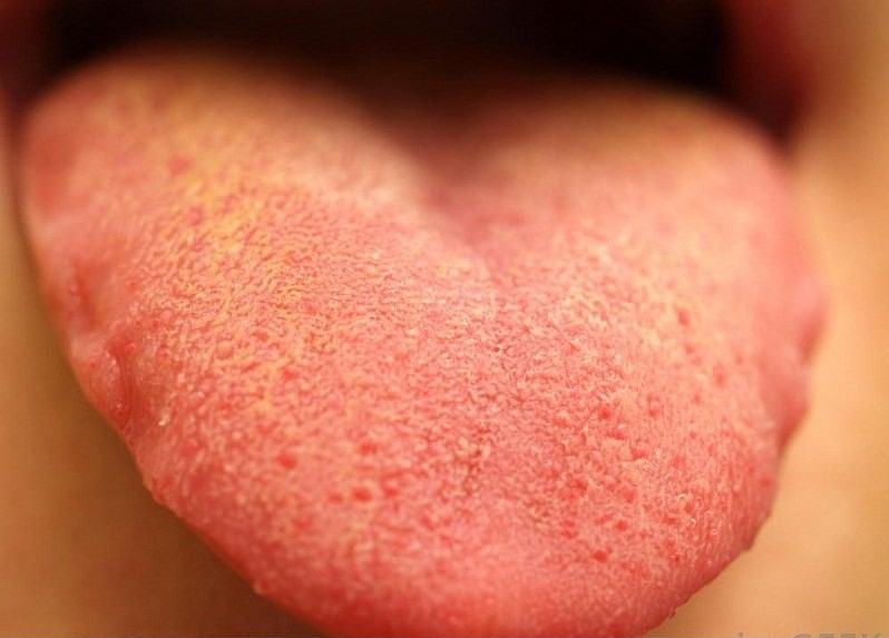 Những dấu hiệu bất thường ở vùng lưỡi cảnh báo một số vấn đề sức khỏe mà bạn không hề hay biết - Ảnh 5.
