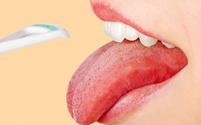Những dấu hiệu bất thường ở vùng lưỡi cảnh báo một số vấn đề sức khỏe mà bạn không hề hay biết - Ảnh 3.