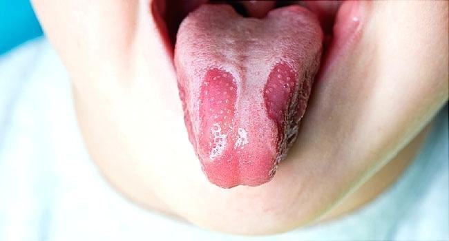 Những dấu hiệu bất thường ở vùng lưỡi cảnh báo một số vấn đề sức khỏe mà bạn không hề hay biết - Ảnh 4.