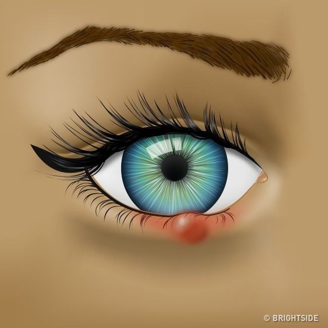 Mắt đột nhiên đỏ ngầu có thể là do 4 nguyên nhân sức khỏe mà bạn không ngờ đến - Ảnh 3.