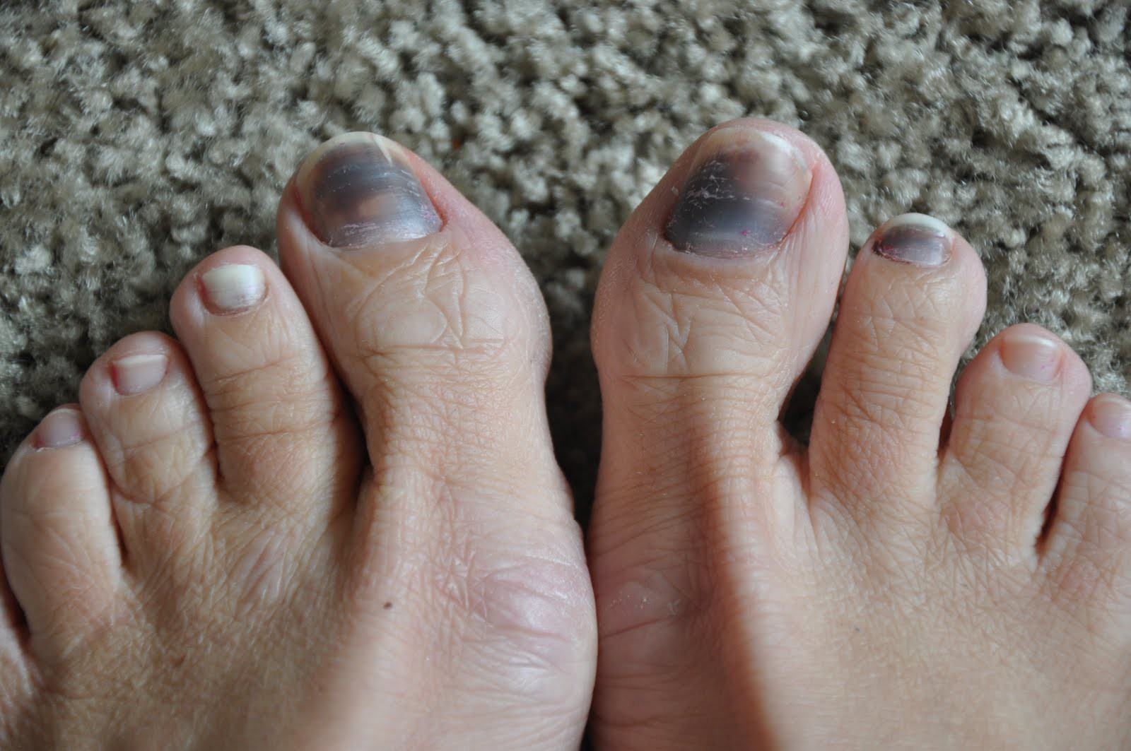 Thấy móng chân tím đen như quả mận là dấu hiệu cảnh báo sức khỏe mà bạn không nên xem thường - Ảnh 2.