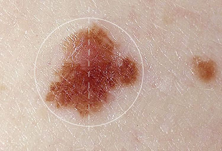 Cẩn thận với 5 dấu hiệu bất thường của nốt ruồi cũng có thể cảnh báo nguy cơ mắc bệnh ung thư da - Ảnh 1.