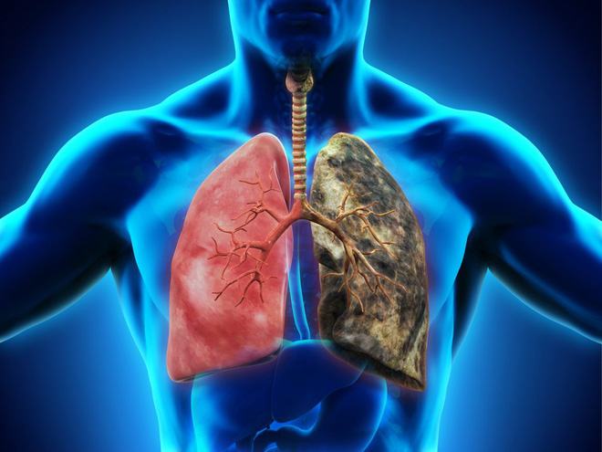 Ung thư phổi đang ngày càng trẻ hoá: đừng để đến lúc phát hiện thì đã quá muộn - Ảnh 1.