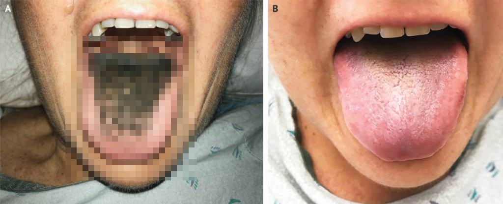 "Lông mọc trong lưỡi" - căn bệnh cực hiếm chứng minh rằng chuyện quái gì cũng có thể xảy ra - Kiến Thức Chia Sẻ 7